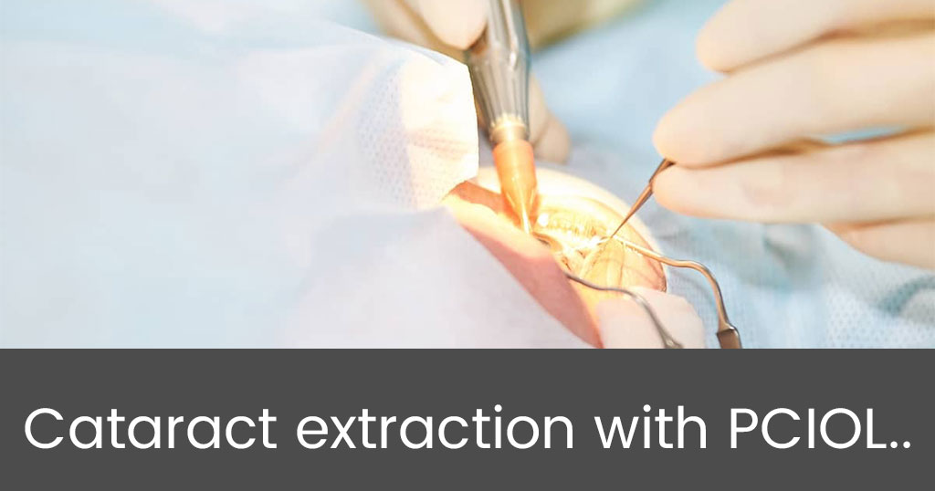 Cataract extraction with PCIOL..