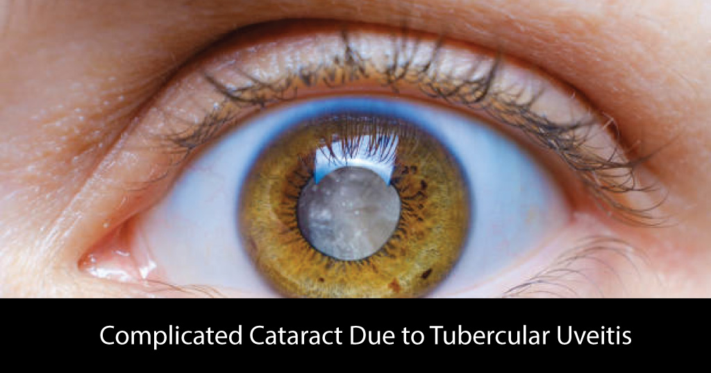 Complicated Cataract Due to Tubercular Uveitis