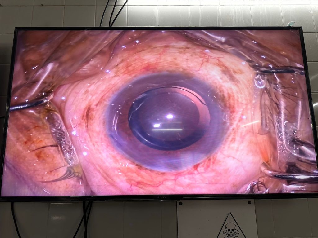 Phaco surgery with PCIOL of a patient of Neurofibromatosis..